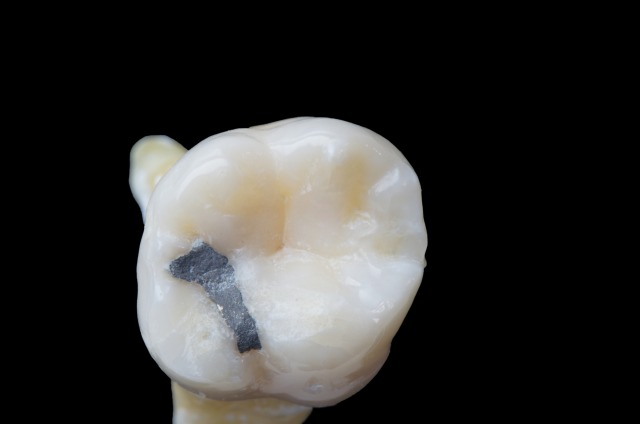 銀歯の方は要注意　水銀を含む「アマルガム」とは
